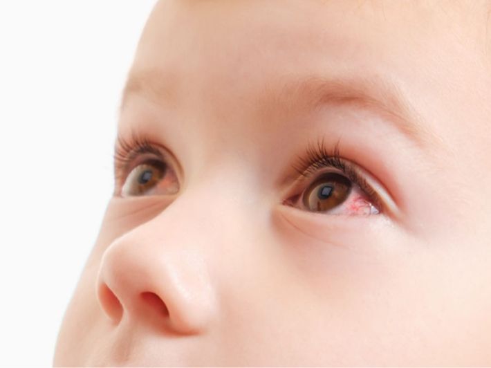 تعرف على أسباب احمرار العين عند الأطفال وطرق العلاج